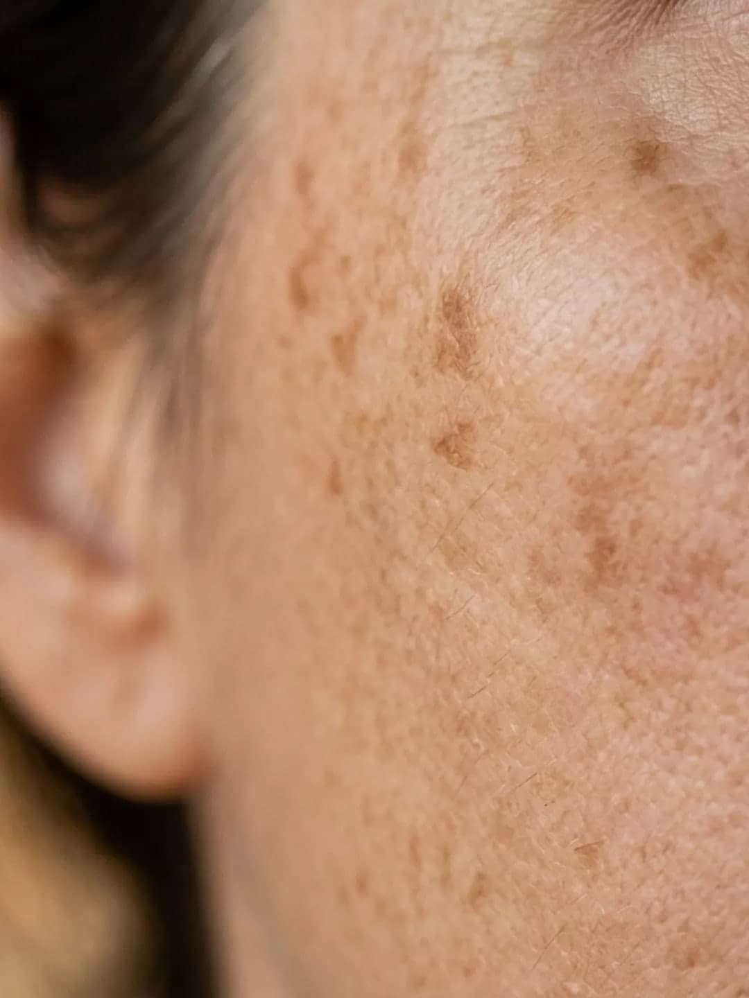Age Spots & Sun Damage