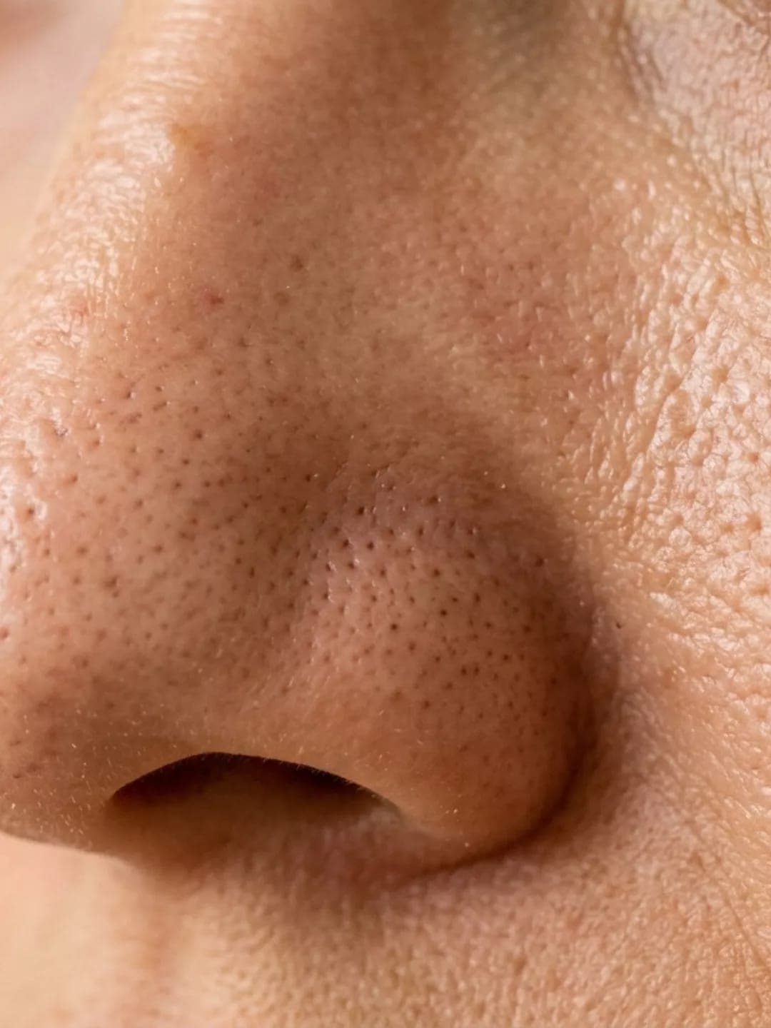 Enlarged Pores