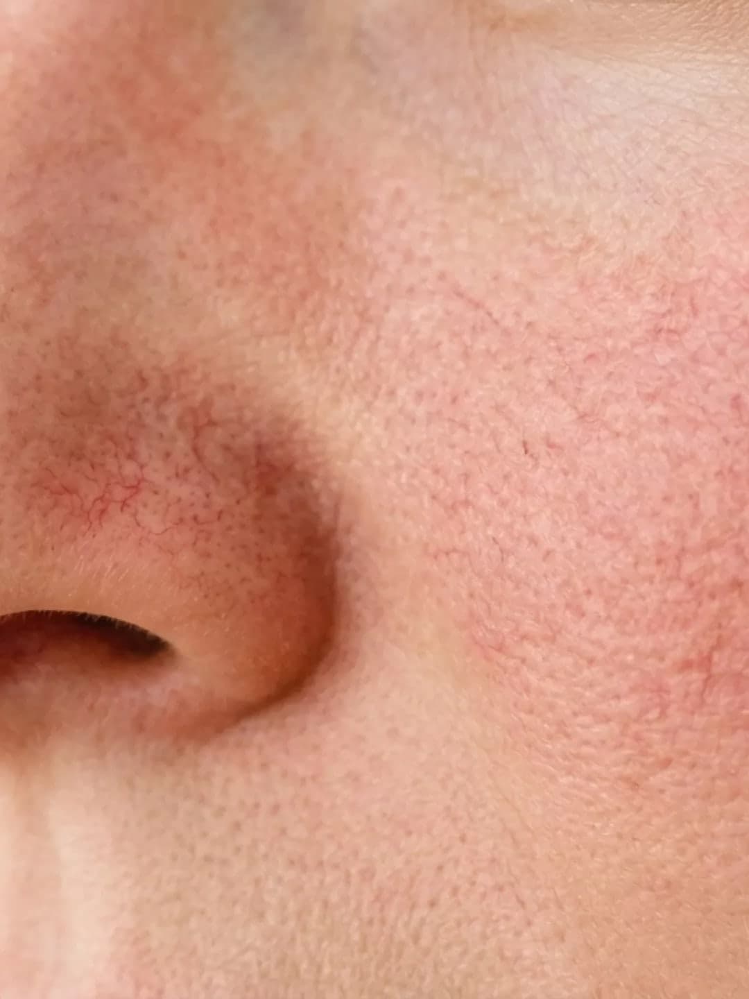 Redness & Rosacea
