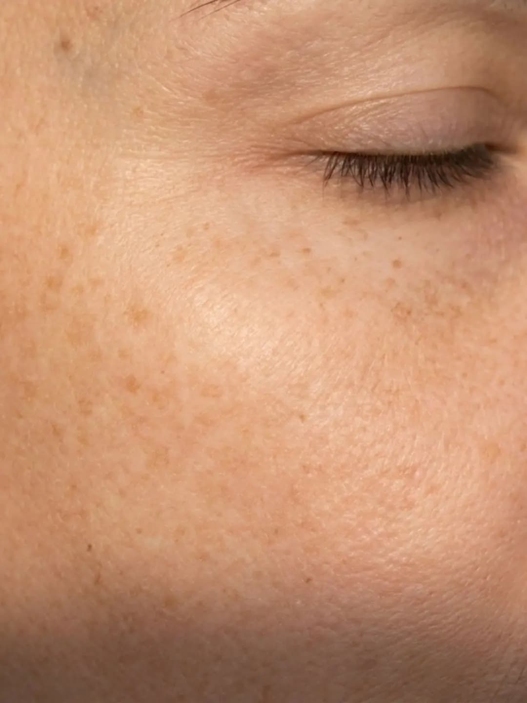 Mild Sun Damage